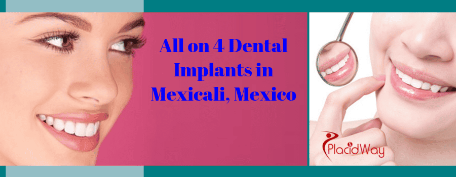 All on 4 Dental Implants in Mexicali, Mexico